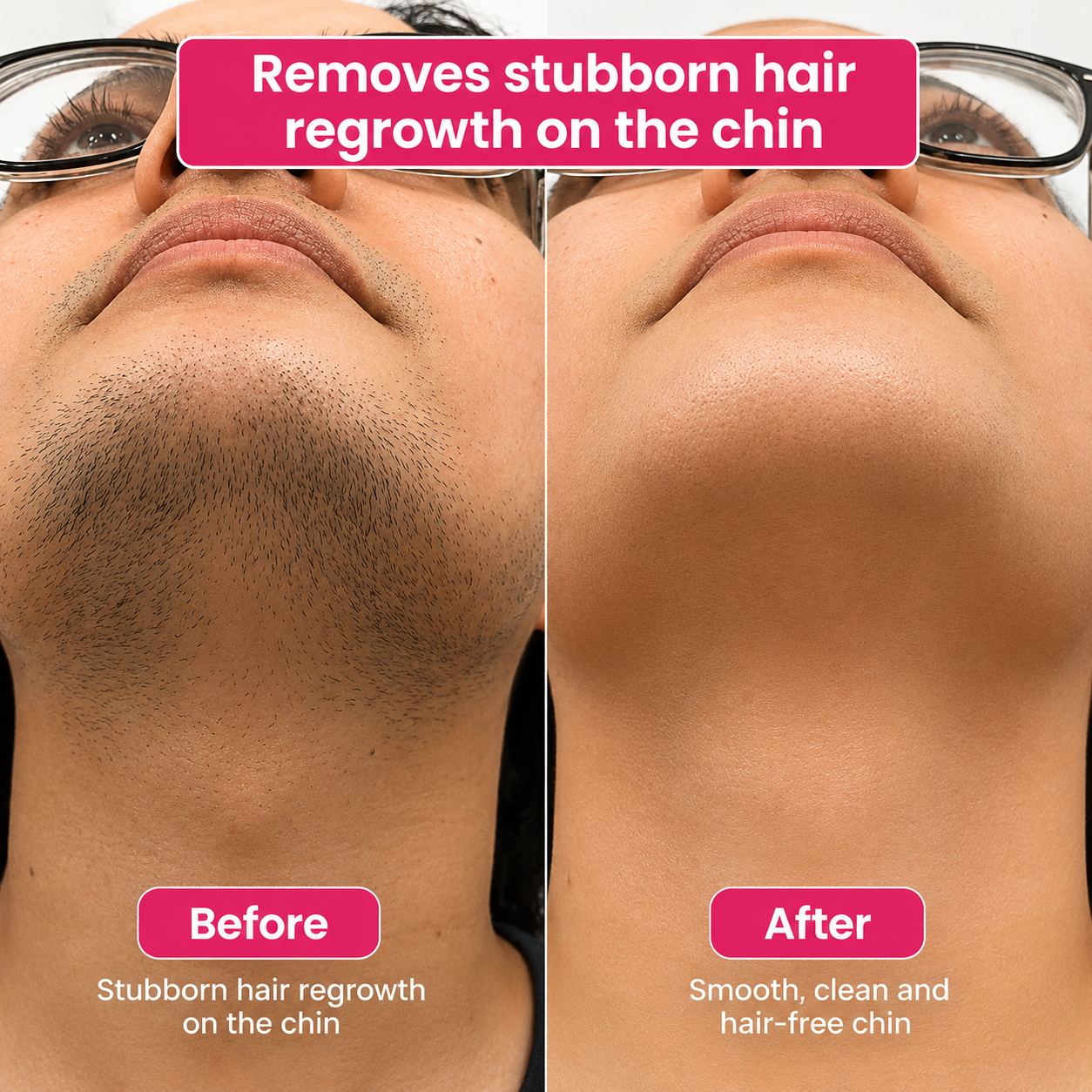 🔥LAST DAY 60% OFF ZAMORAES Hair Reduction Oil 60 ml – Permanent Hair Removal Oil