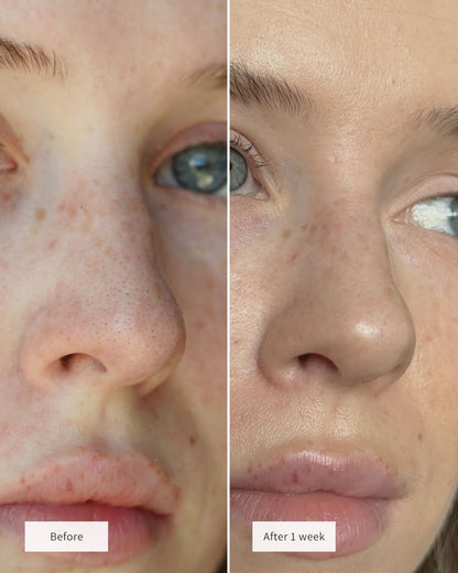 🎁LIMITED SALE - 💕ZAMORAES NOSE PATCHES