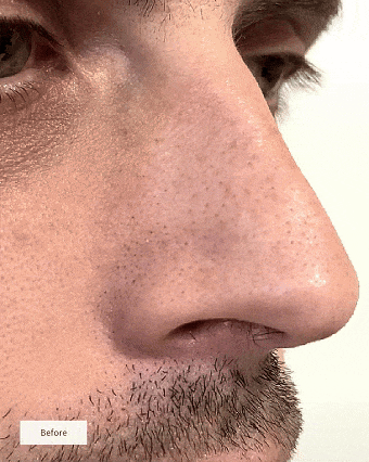 🎁LIMITED SALE - 💕ZAMORAES NOSE PATCHES